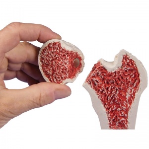 Osteoporosis Femur Model